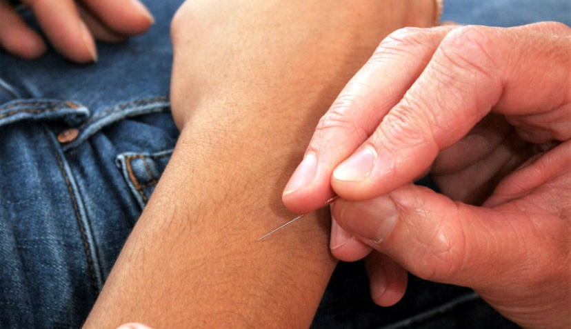 Akupunktur